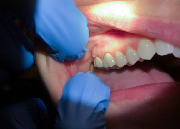 Best Emergency Tooth Extraction in Brice Prairie, WI